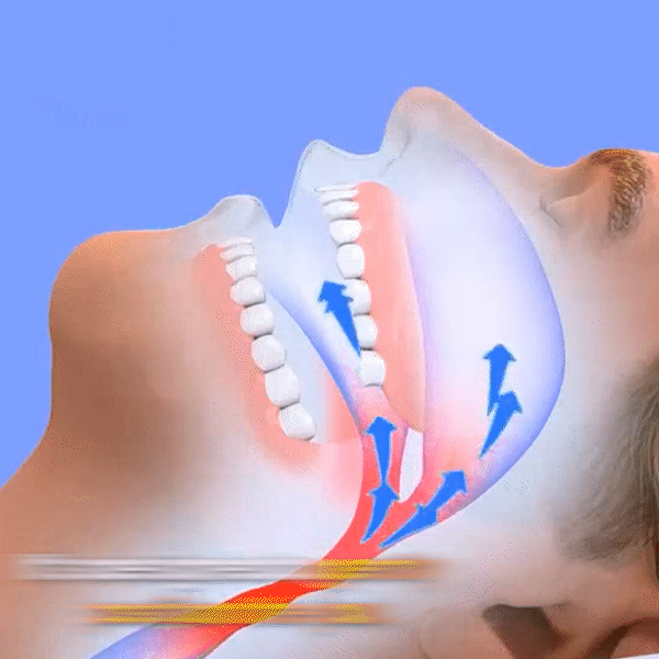SilentBite Snoring Mouth Piece